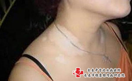 药物治疗女性白癜风要留意什么?长春治疗白癜风權威的医院