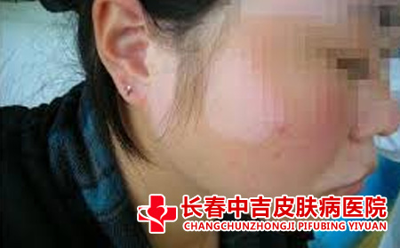 长春哪里治疗白癜风
