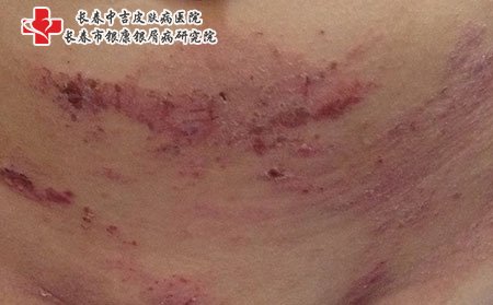 湿疹图片